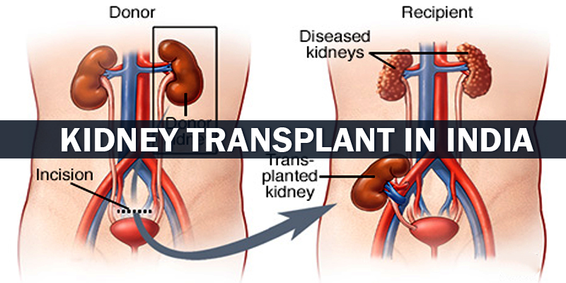 Donate your kidney legally for the sum of $450,000 USD