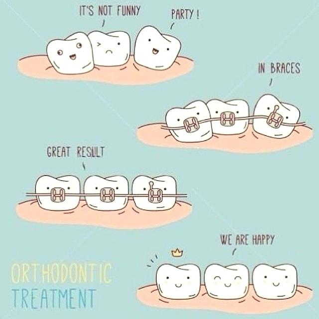 Dental Veneers
