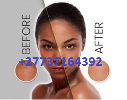 Skin Lightening injection And Creams For Sale In Nairobi, Kenya +27737164392. Public ·… Sangweni Tembisa. Kempton Park, South Africa.