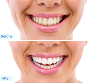 Invisalign Before And After