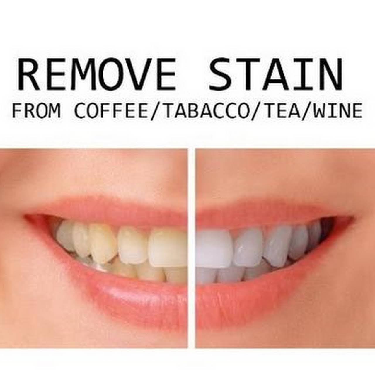 Invisalign Before And After