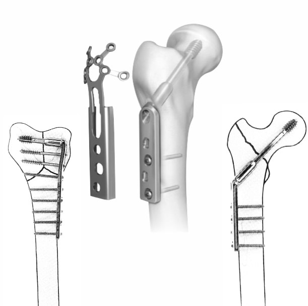 International Standard Quality Orthopaedic Implants