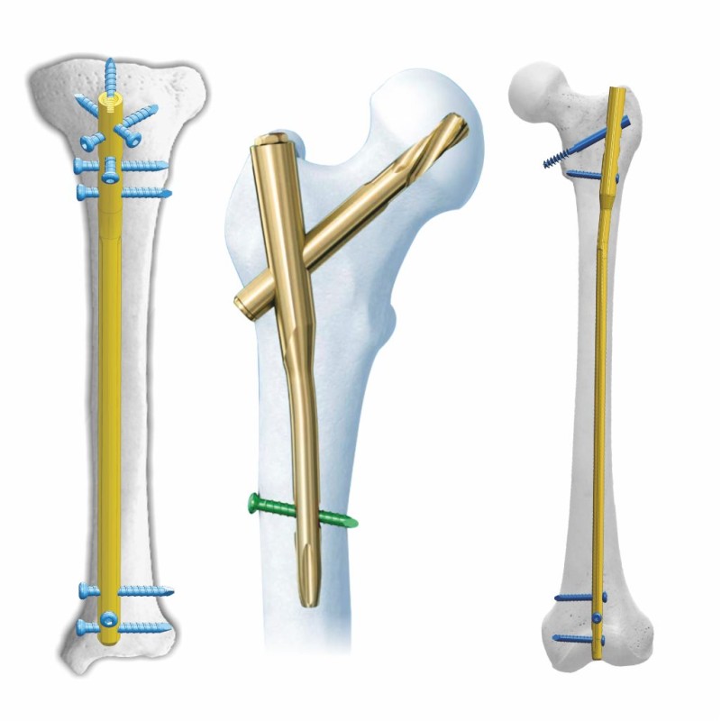 International Standard Quality Orthopaedic Implants