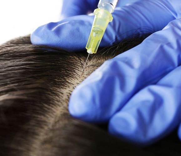Hair Transplant in London – Fortes Clinic